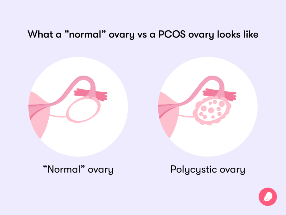 Healthy ovaries are smaller and do not have the characteristic appearance of multiple small follicles seen in polycystic ovaries.